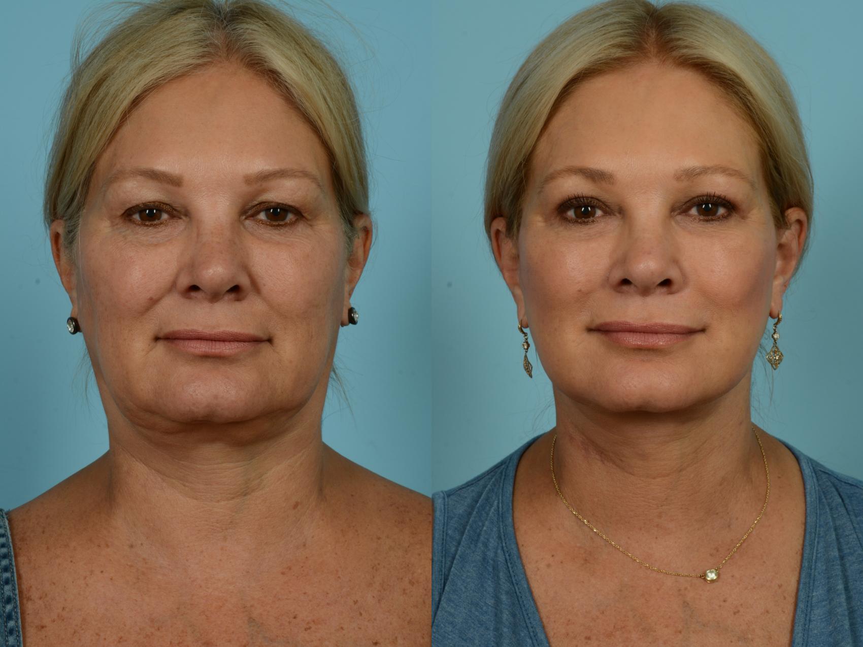 Before & After Neck Lift by Dr. Sinno Case 869 Front View in Chicago, IL