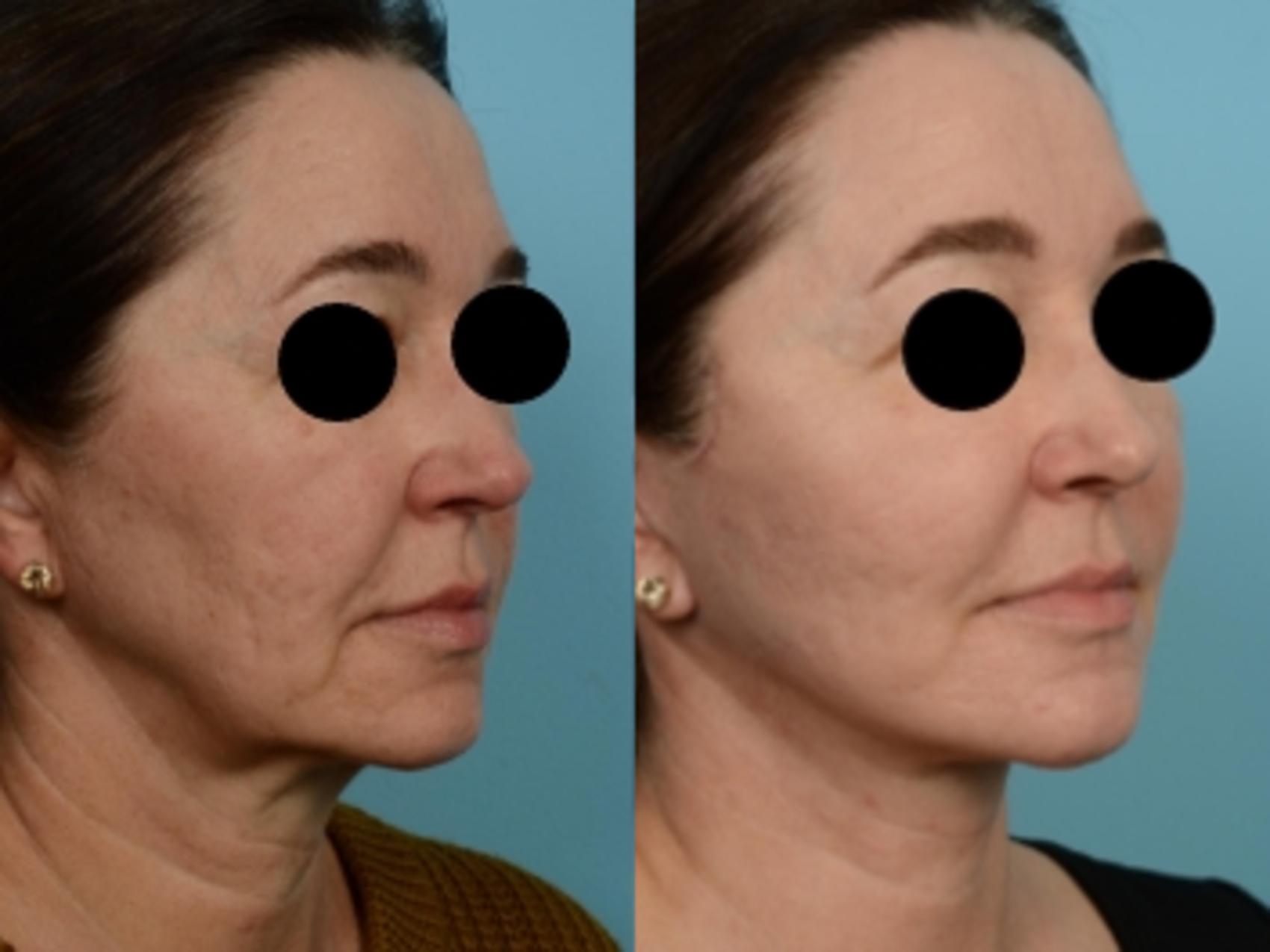 Dr. Sinno Facelift in Chicago, Illinois