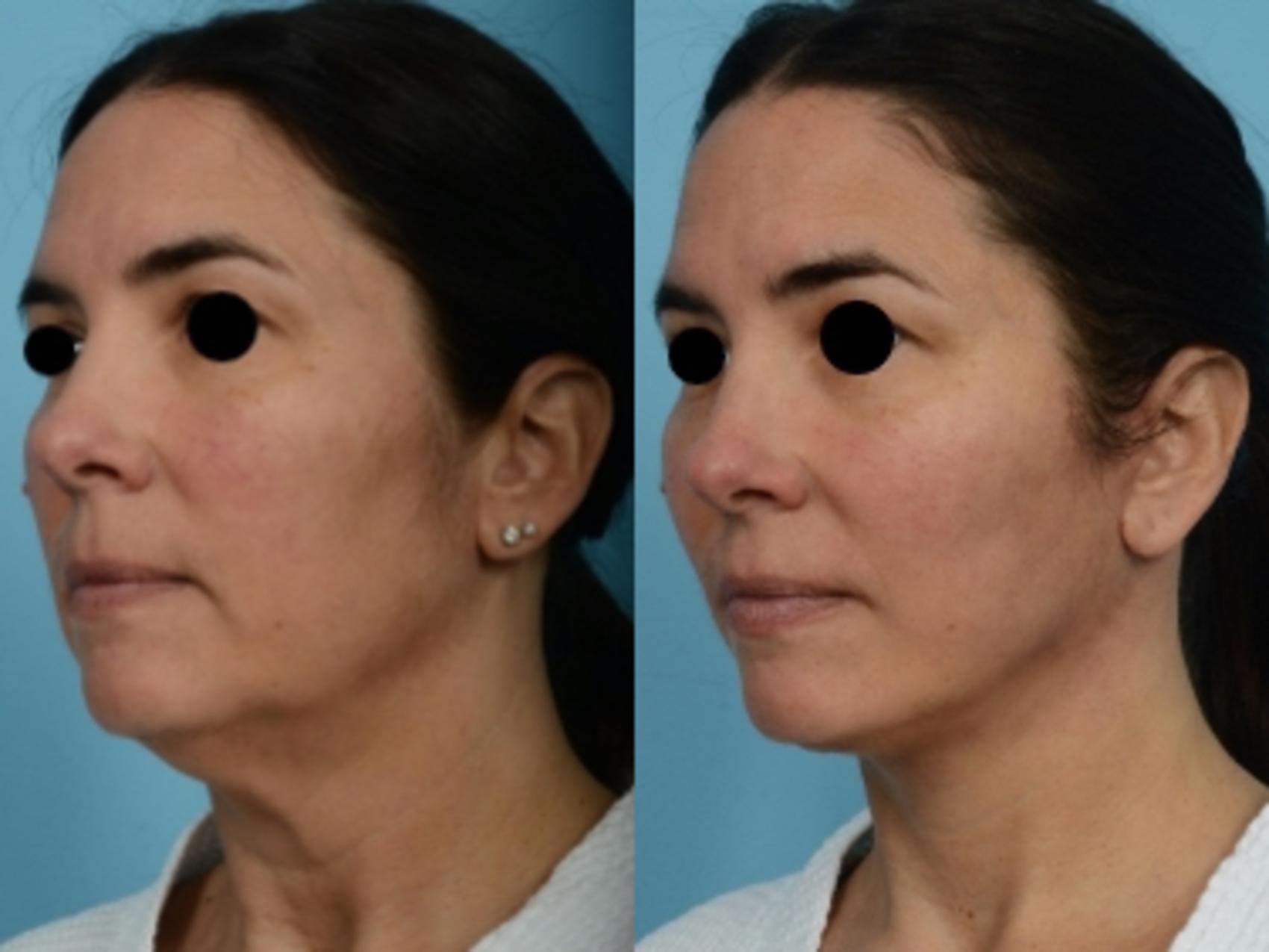 Dr. Sinno Facelift in Chicago, Illinois