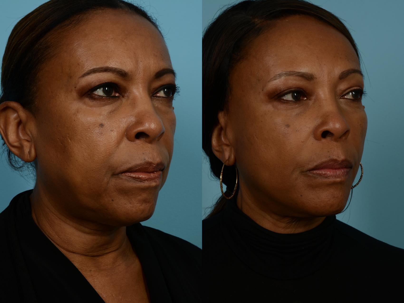 Before & After Dual Plane Facelift by Dr. Sinno Case 690 Right Oblique View in Chicago, IL