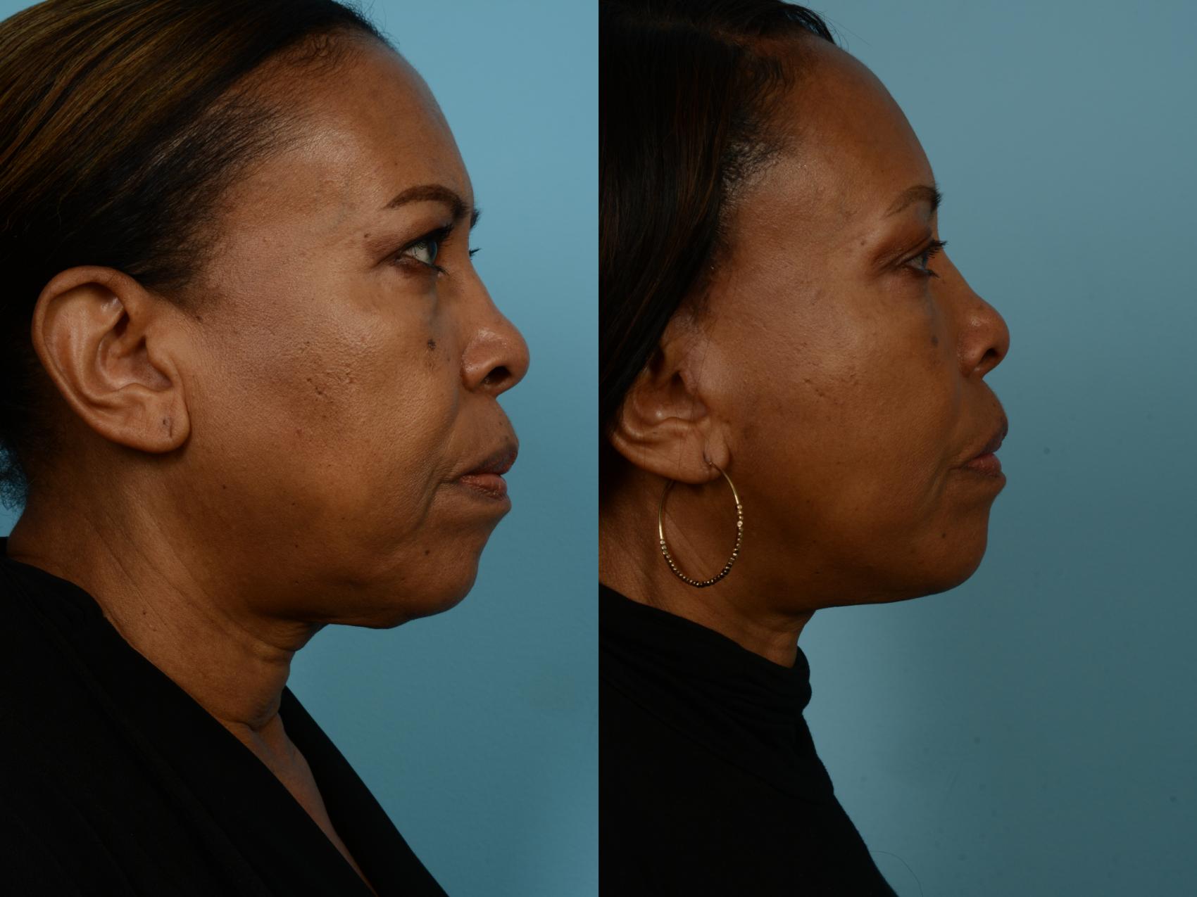 Before & After Dual Plane Facelift by Dr. Sinno Case 690 Right Side View in Chicago, IL