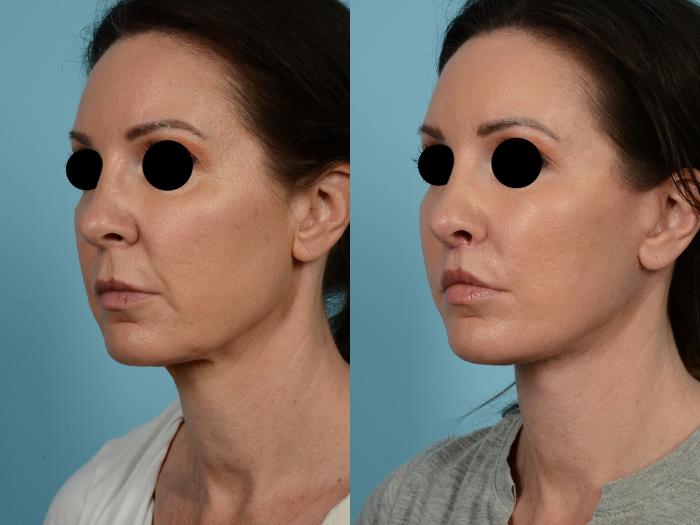 Dr. Sinno Facelift in Chicago, Illinois