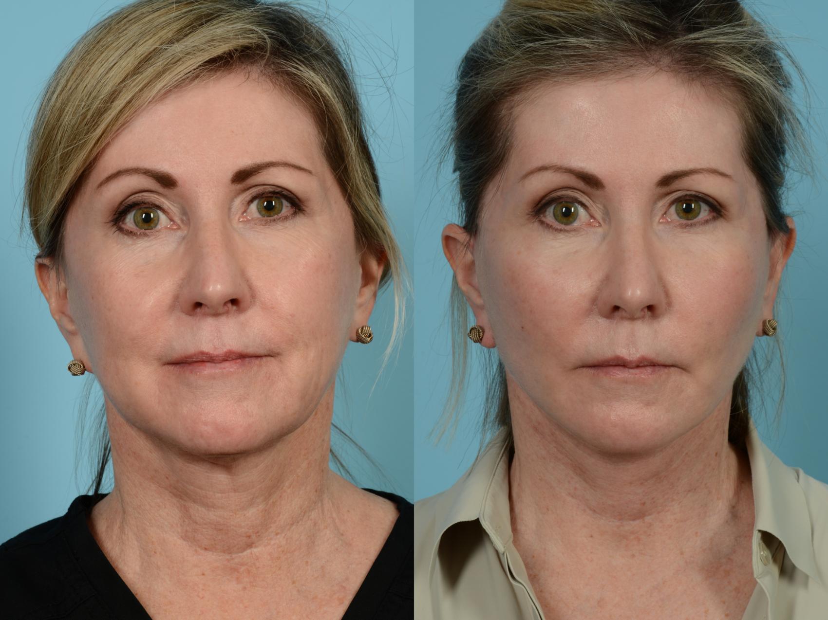 Dr. Sinno Facelift in Chicago, Illinois