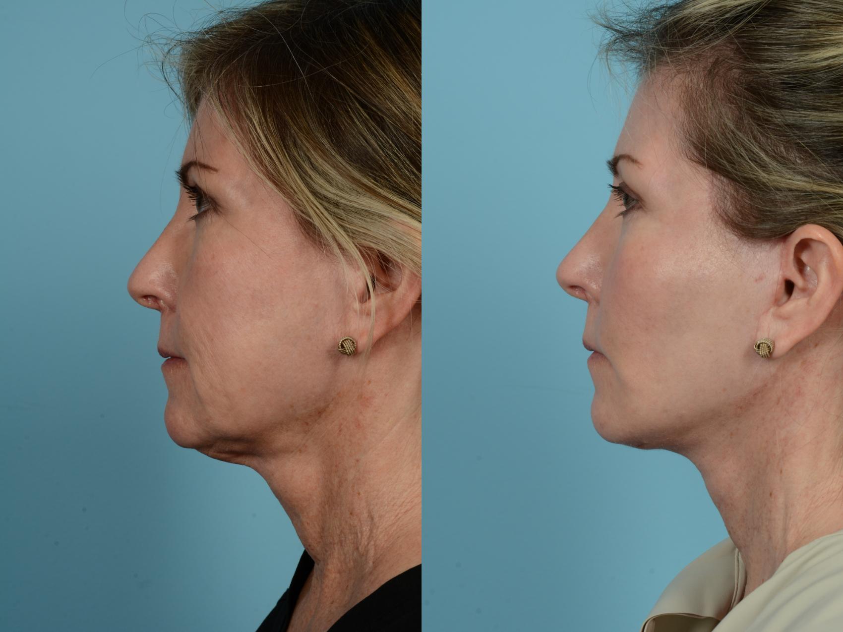 Dr. Sinno Facelift in Chicago, Illinois