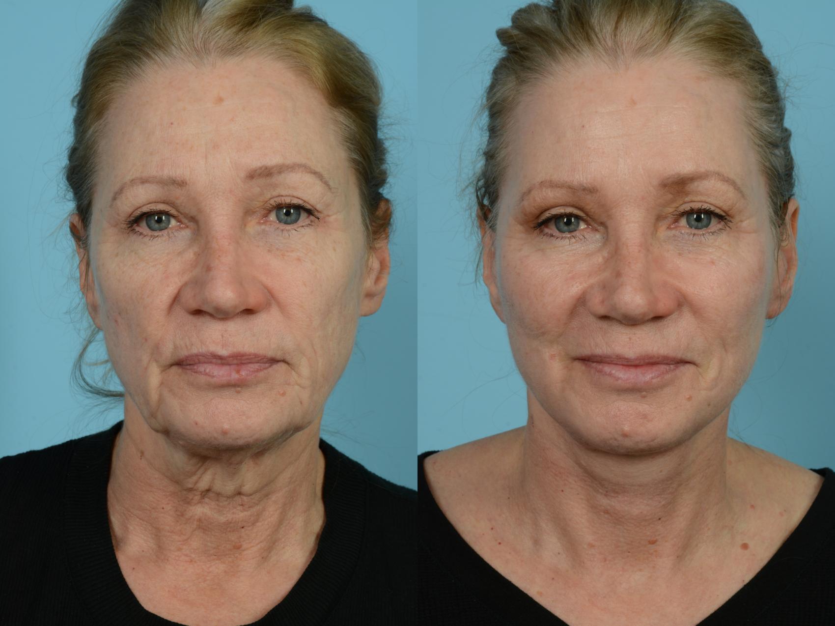 Dr. Sinno Facelift in Chicago, Illinois