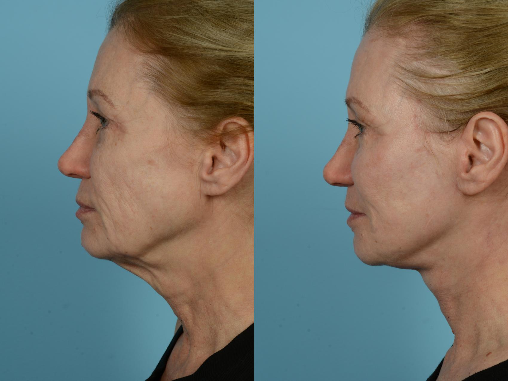 Dr. Sinno Facelift in Chicago, Illinois