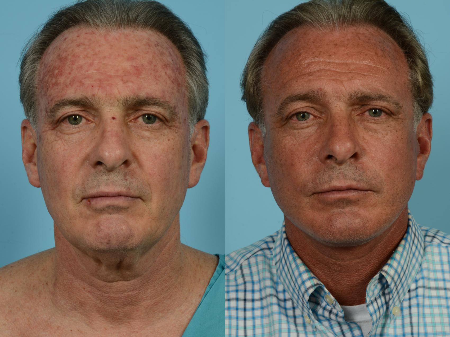 Dr. Sinno Facelift in Chicago, Illinois