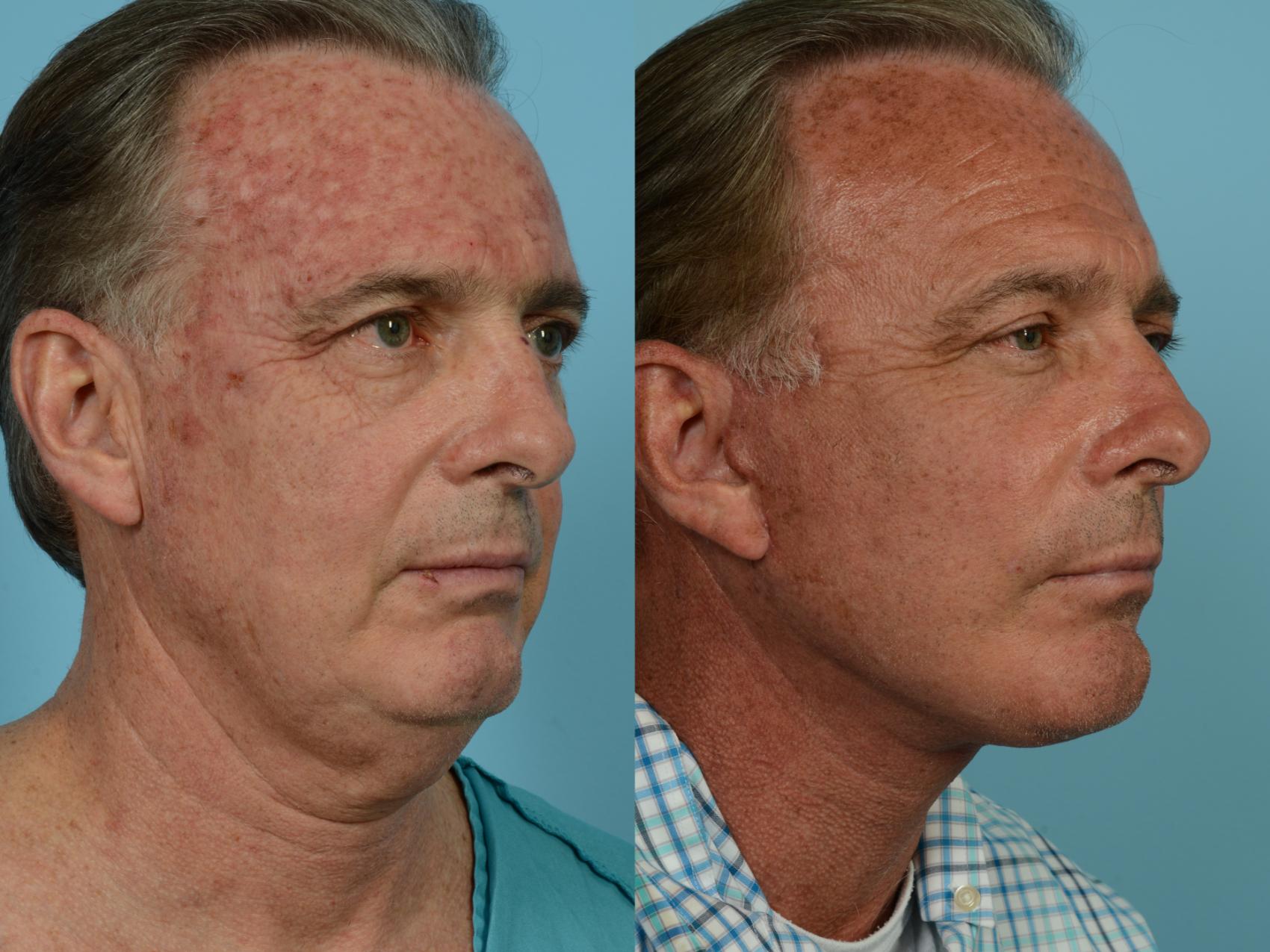 Dr. Sinno Facelift in Chicago, Illinois