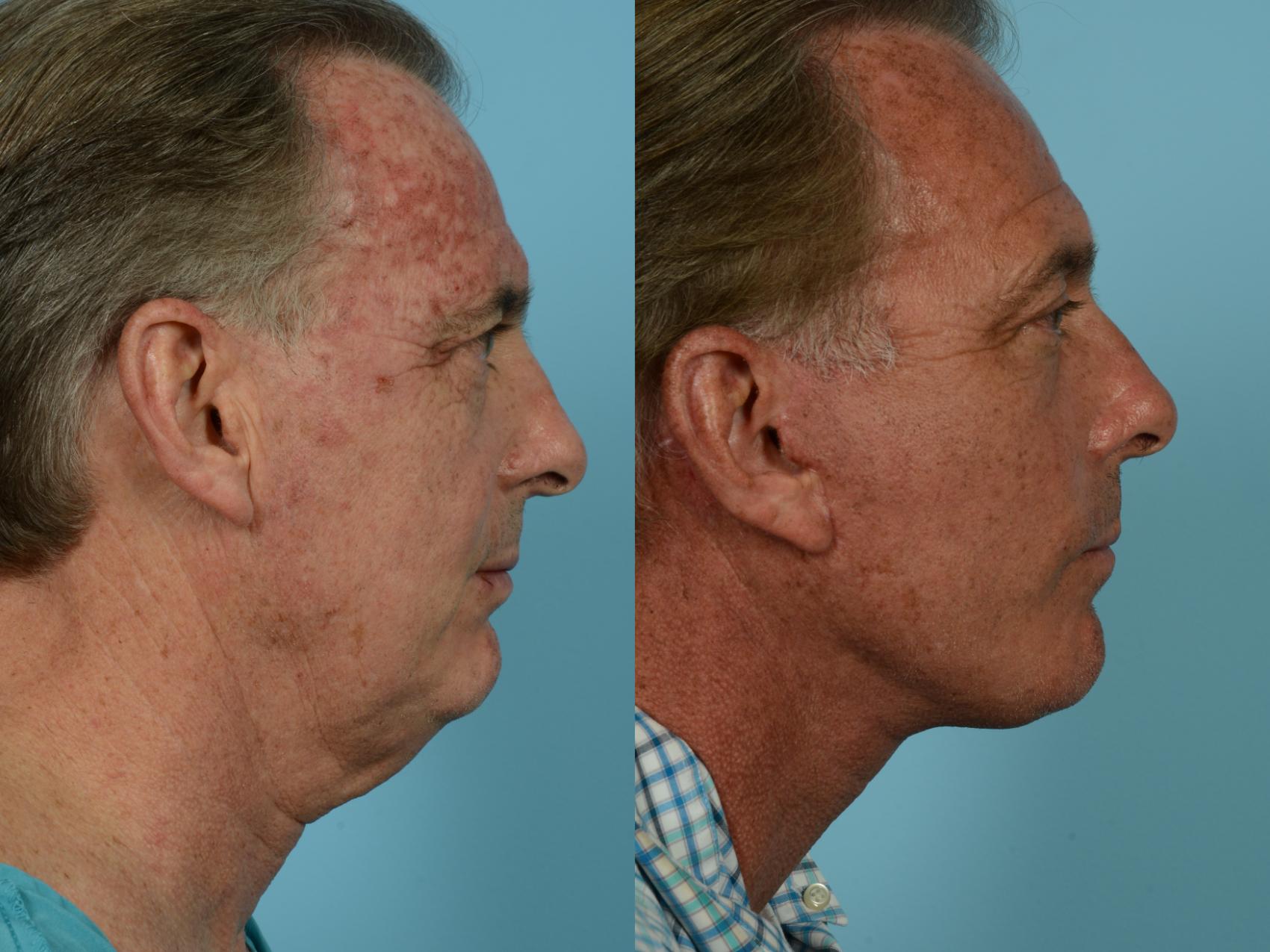 Dr. Sinno Facelift in Chicago, Illinois