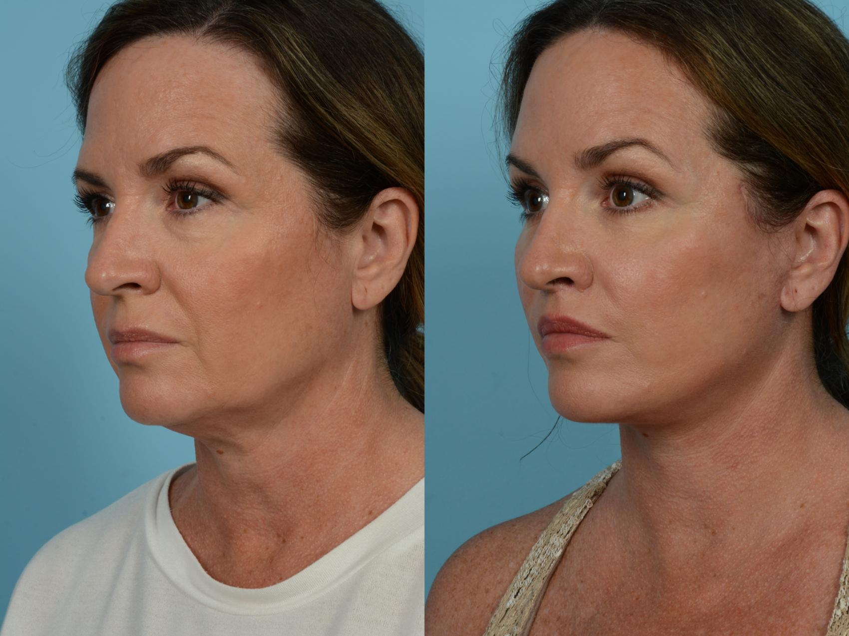 Dr. Sinno Facelift in Chicago, Illinois
