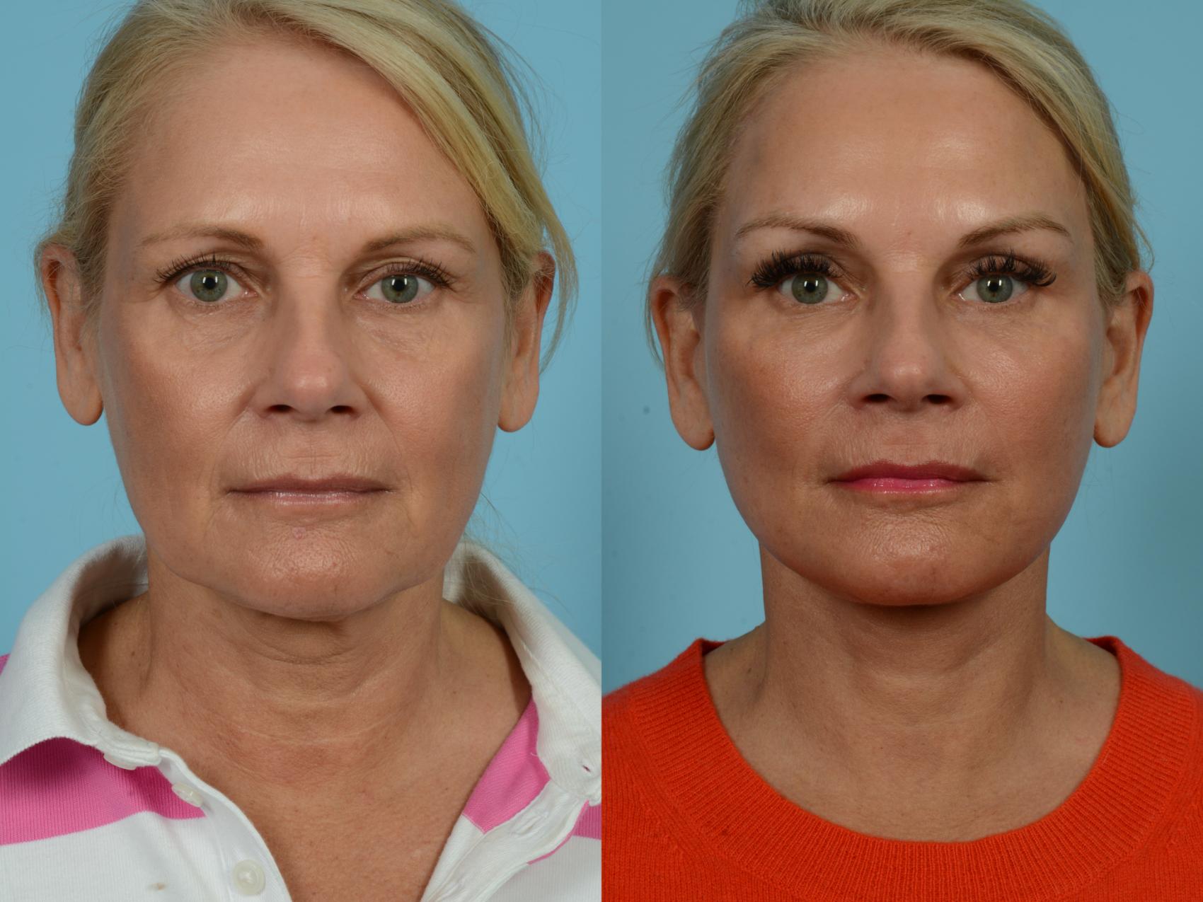 Before & After Dual Plane Facelift by Dr. Sinno Case 781 Front View in Chicago, IL