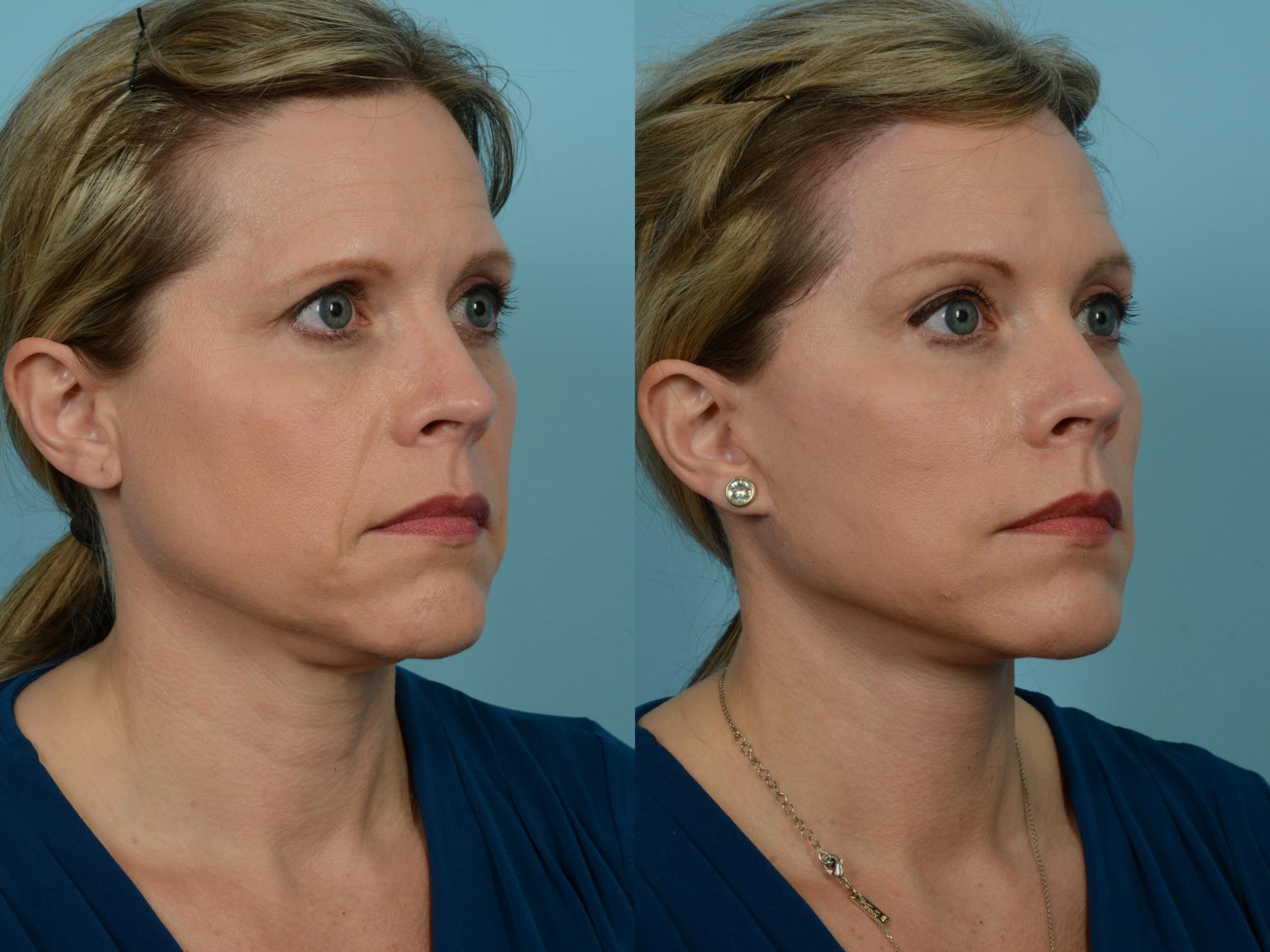 Before & After Dual Plane Facelift by Dr. Sinno Case 784 Right Oblique View in Chicago, IL