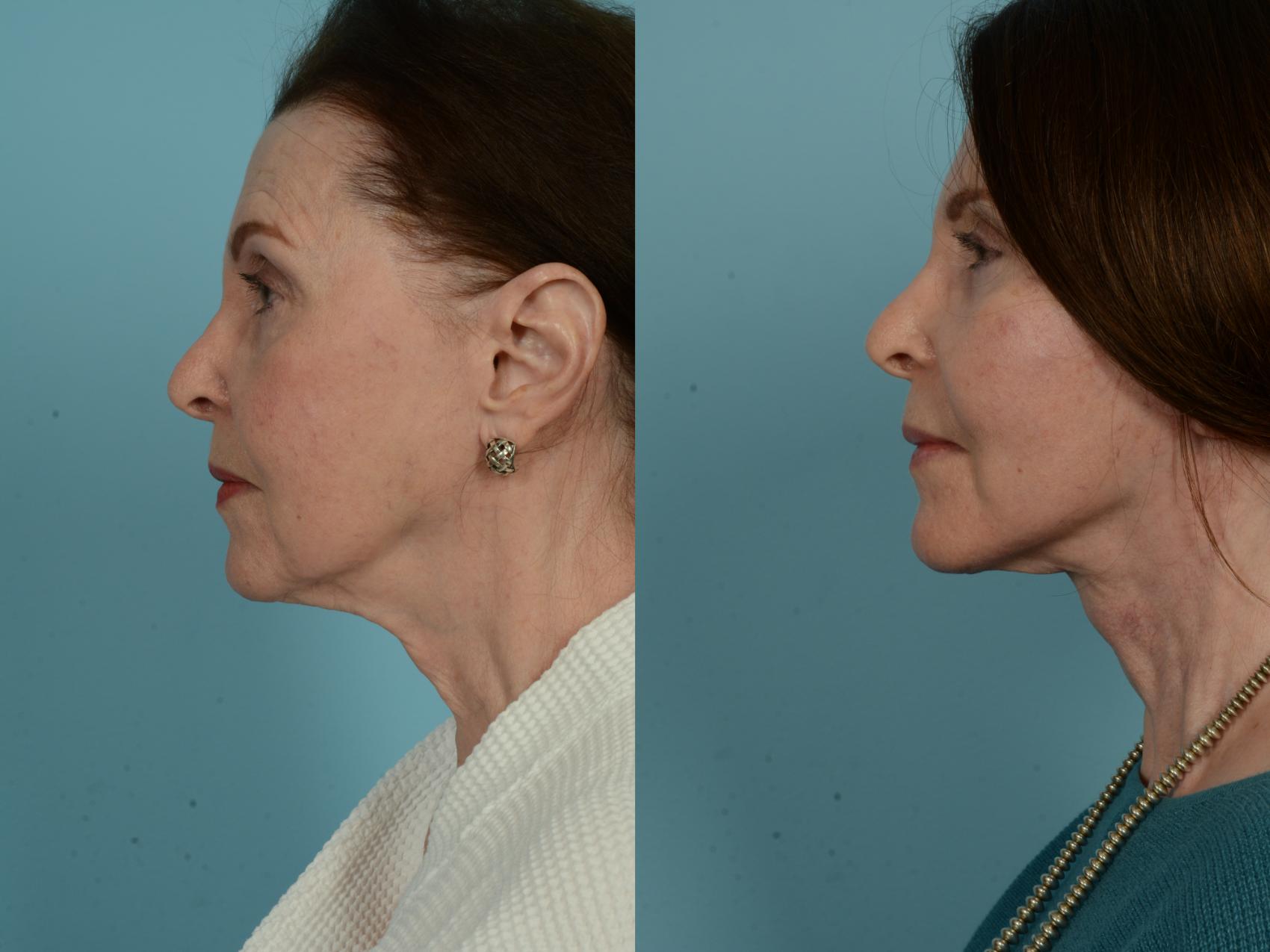 Before & After Dual Plane Facelift by Dr. Sinno Case 911 Left Side View in Chicago, IL