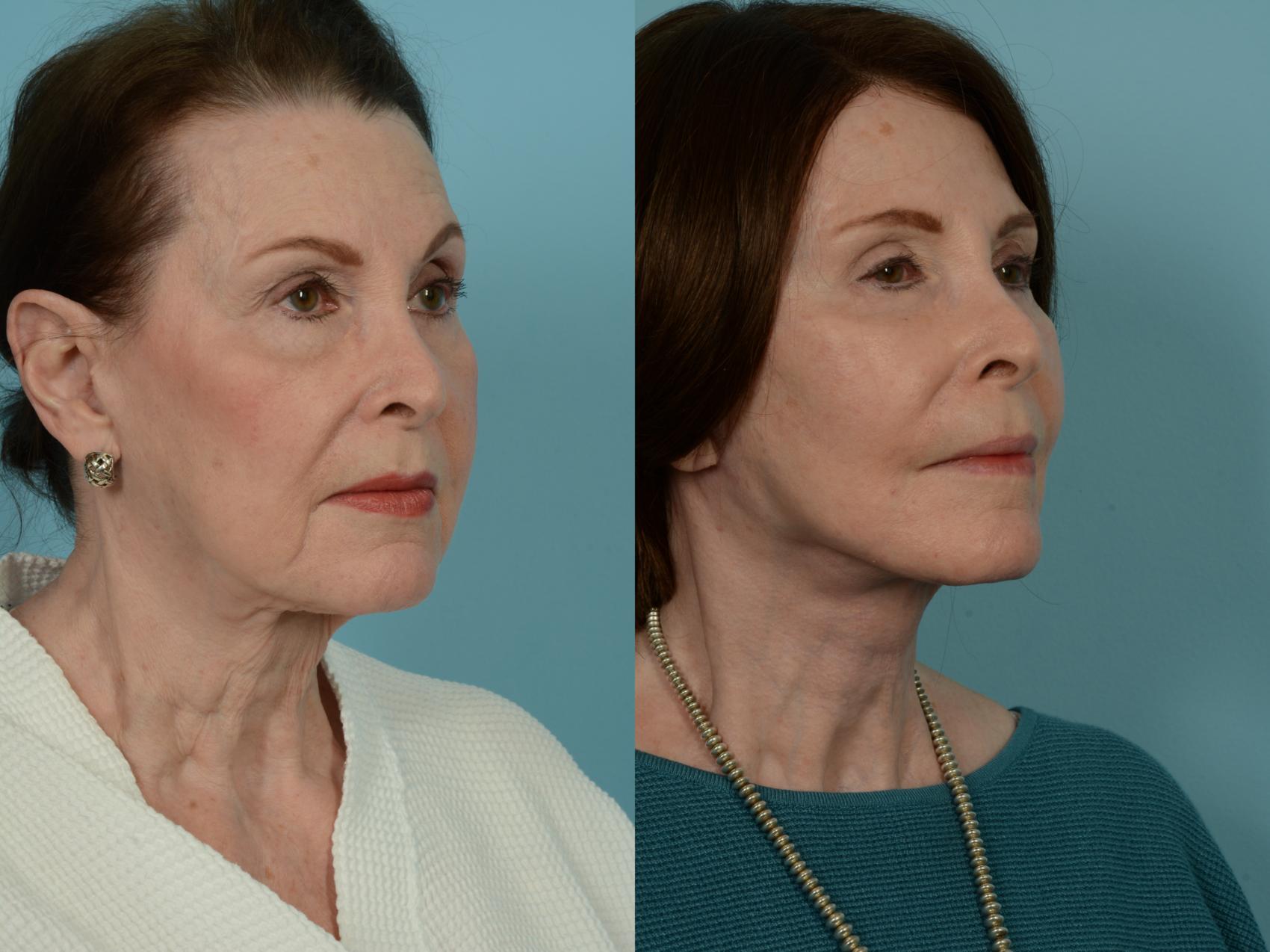 Before & After Dual Plane Facelift by Dr. Sinno Case 911 Right Oblique View in Chicago, IL