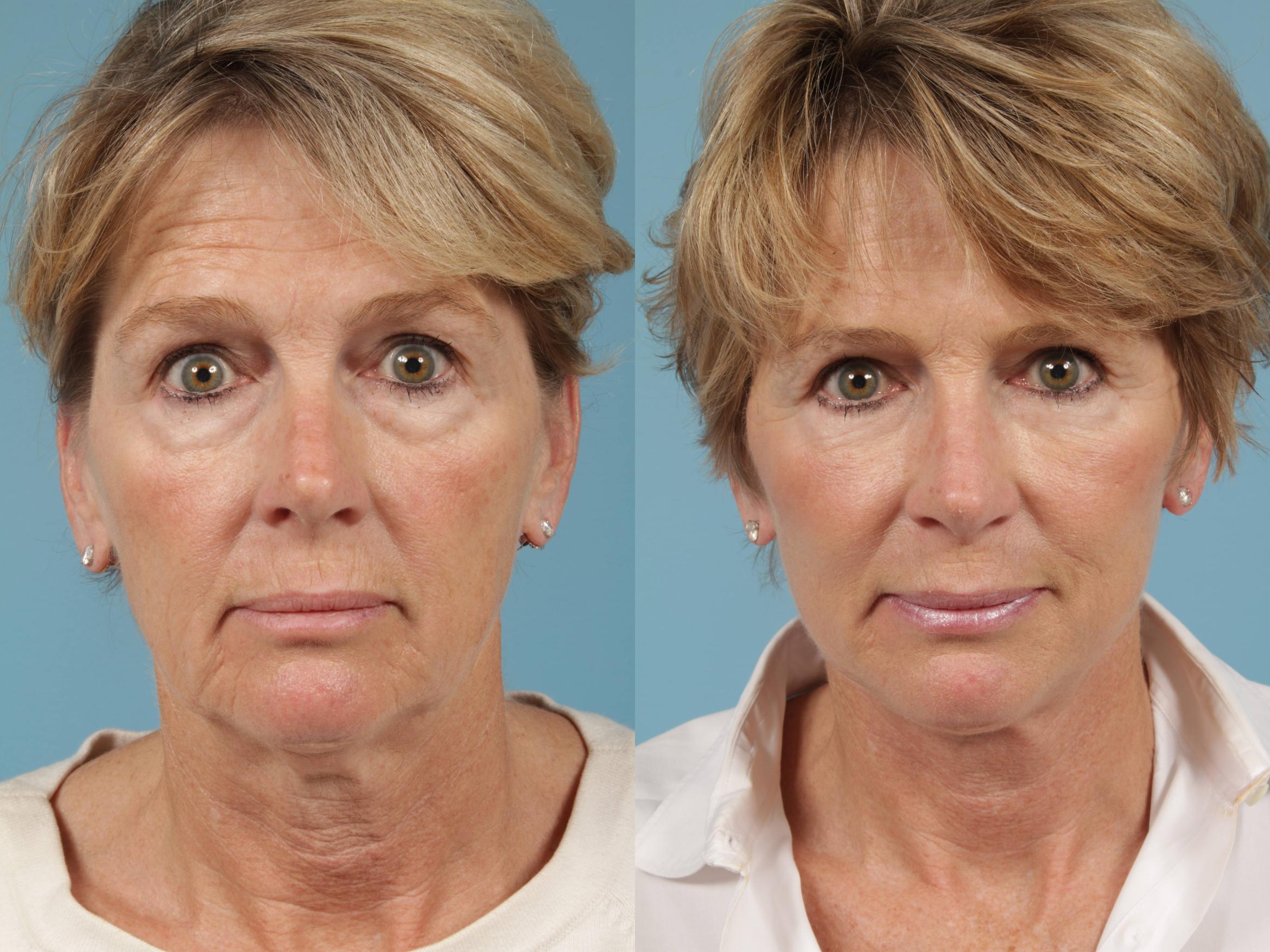 Before & After Eyelid Surgery Case 216 View #1 View in Chicago, IL