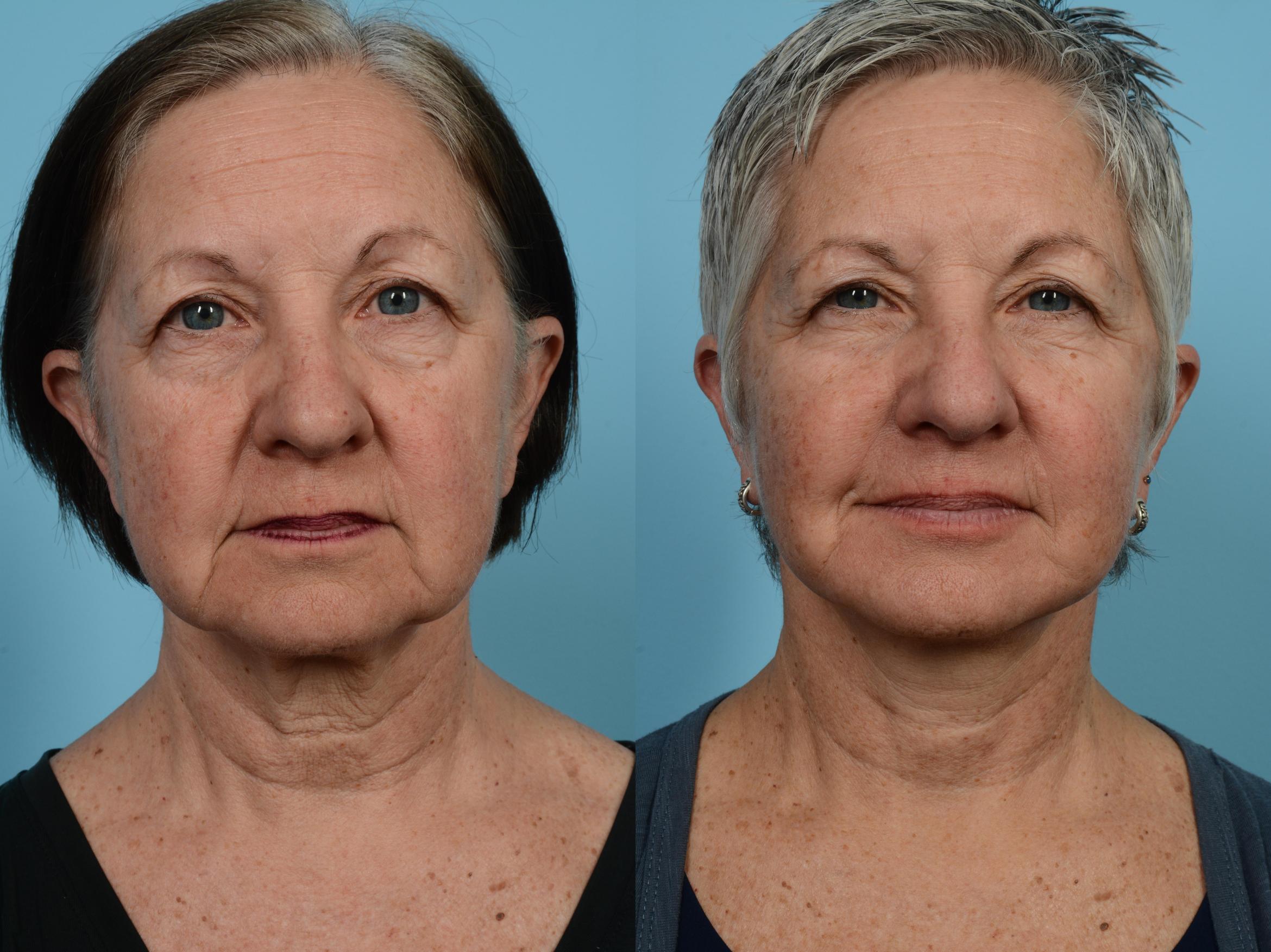 Before & After Facelift/Minilift Case 569 View #1 View in Chicago, IL