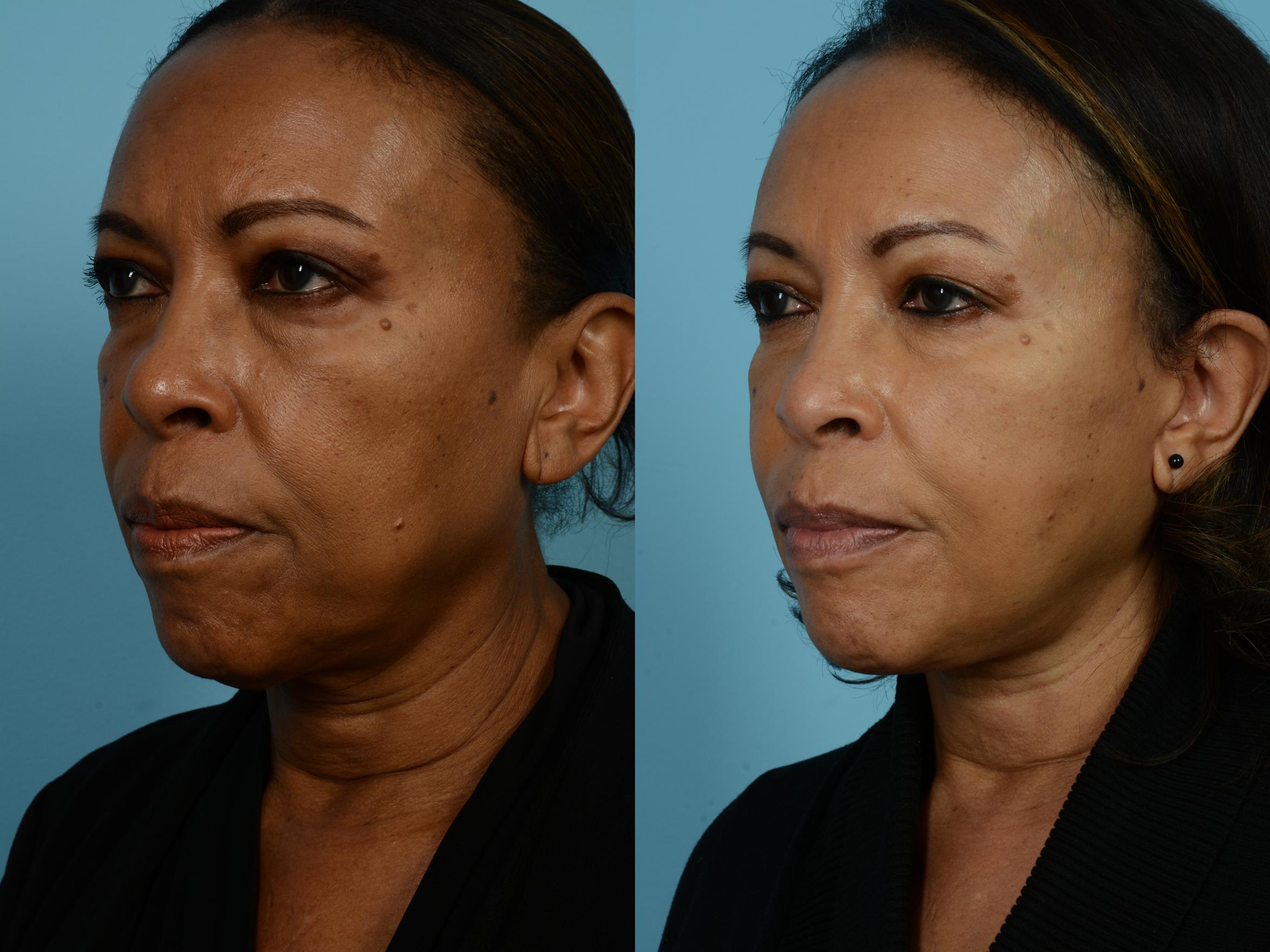 Dr. Sinno Facelift in Chicago, Illinois