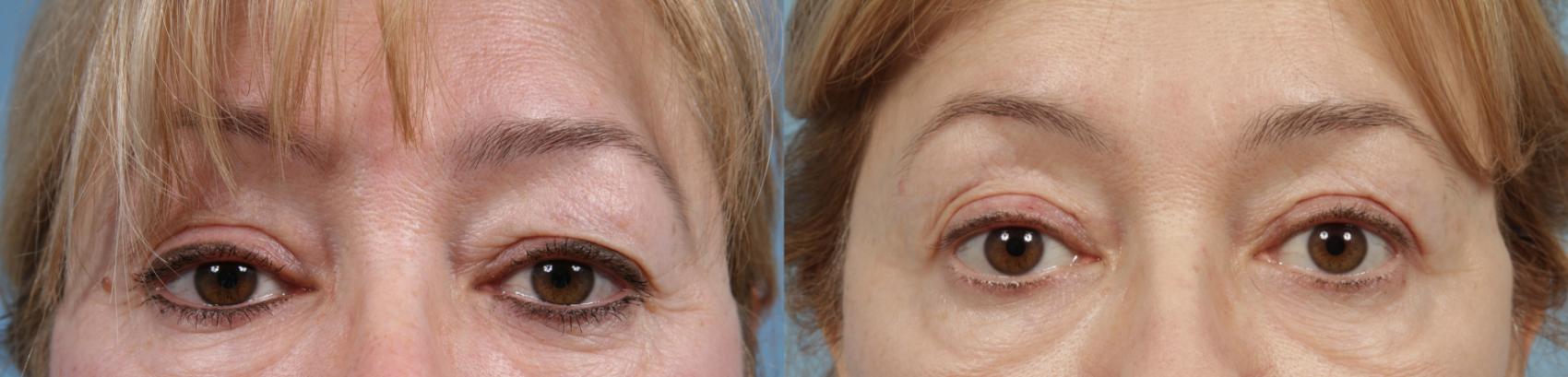 Before & After Deep Plane Facelift by Dr. Mustoe Case 183 Upper Blepharoplasty with Brow Lift View in Chicago, IL