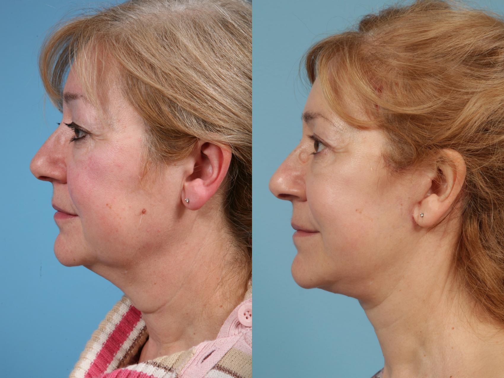 Before & After Deep Plane Facelift by Dr. Mustoe Case 183 View #2 View in Chicago, IL