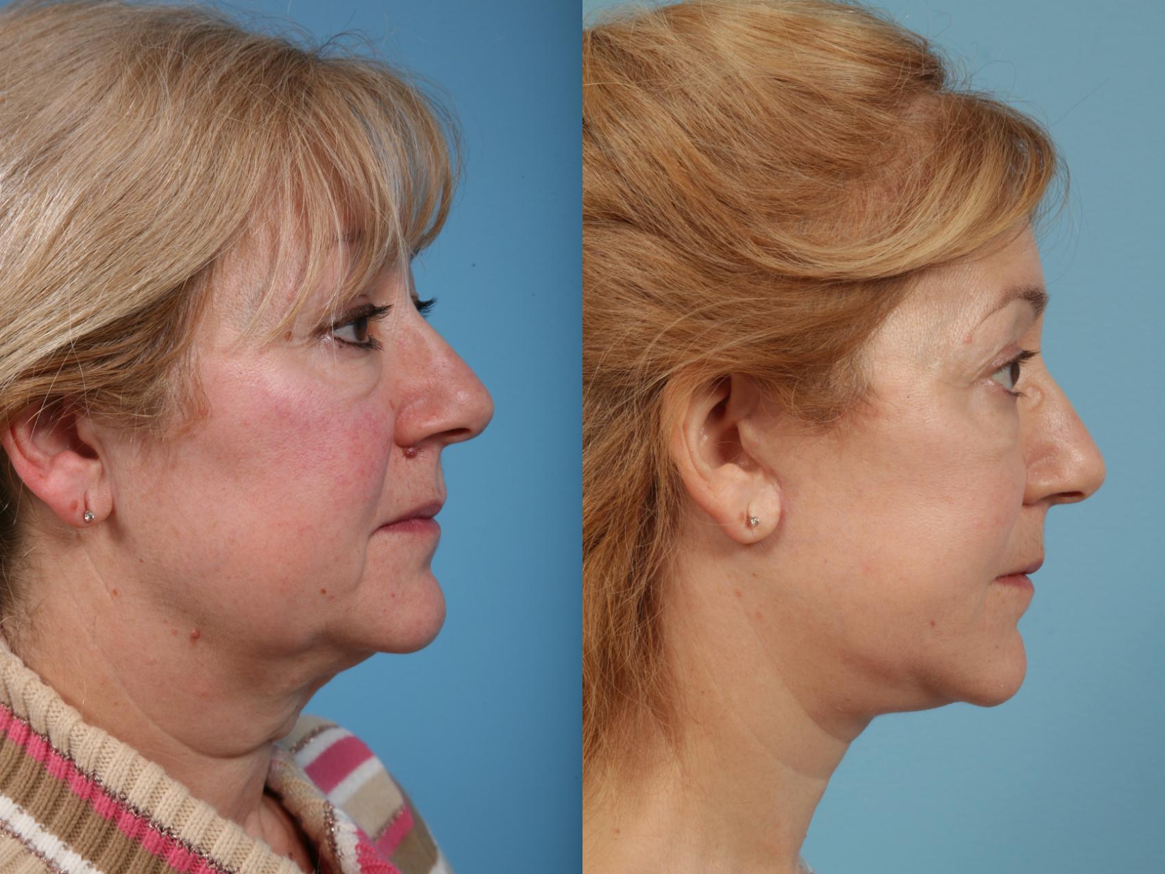 Before & After Deep Plane Facelift by Dr. Mustoe Case 183 View #3 View in Chicago, IL