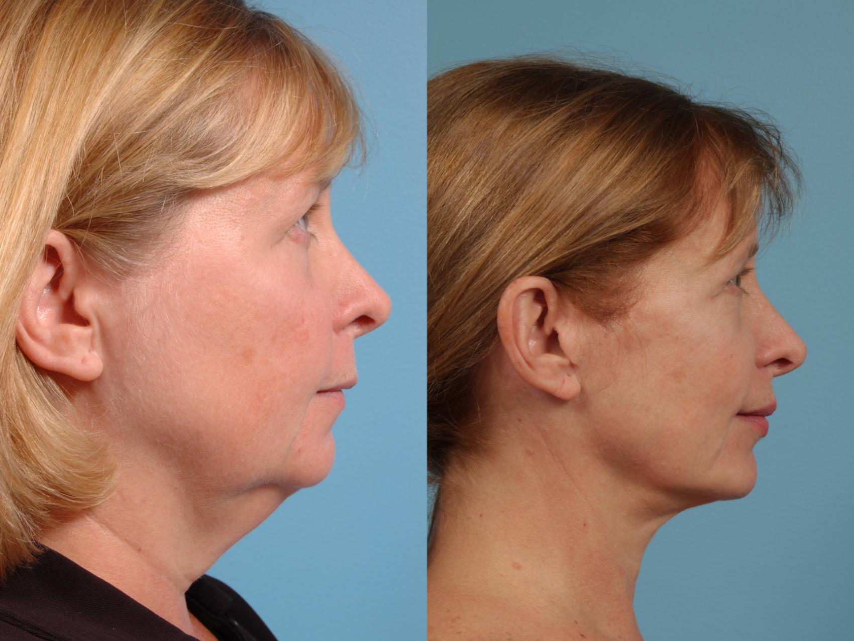 Before & After Deep Plane Facelift by Dr. Mustoe Case 196 Right Side View in Chicago, IL