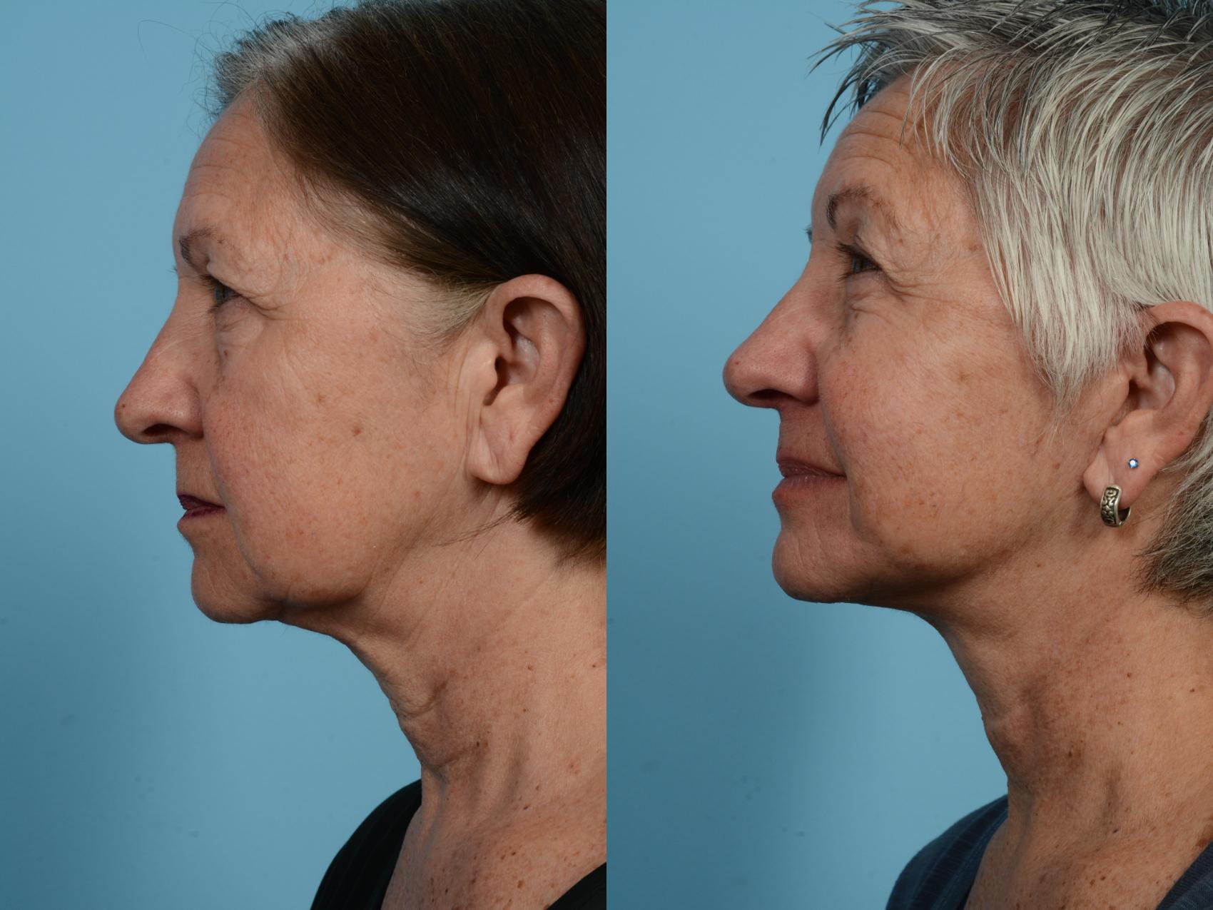 Before & After Deep Plane Facelift by Dr. Mustoe Case 569 View #2 View in Chicago, IL