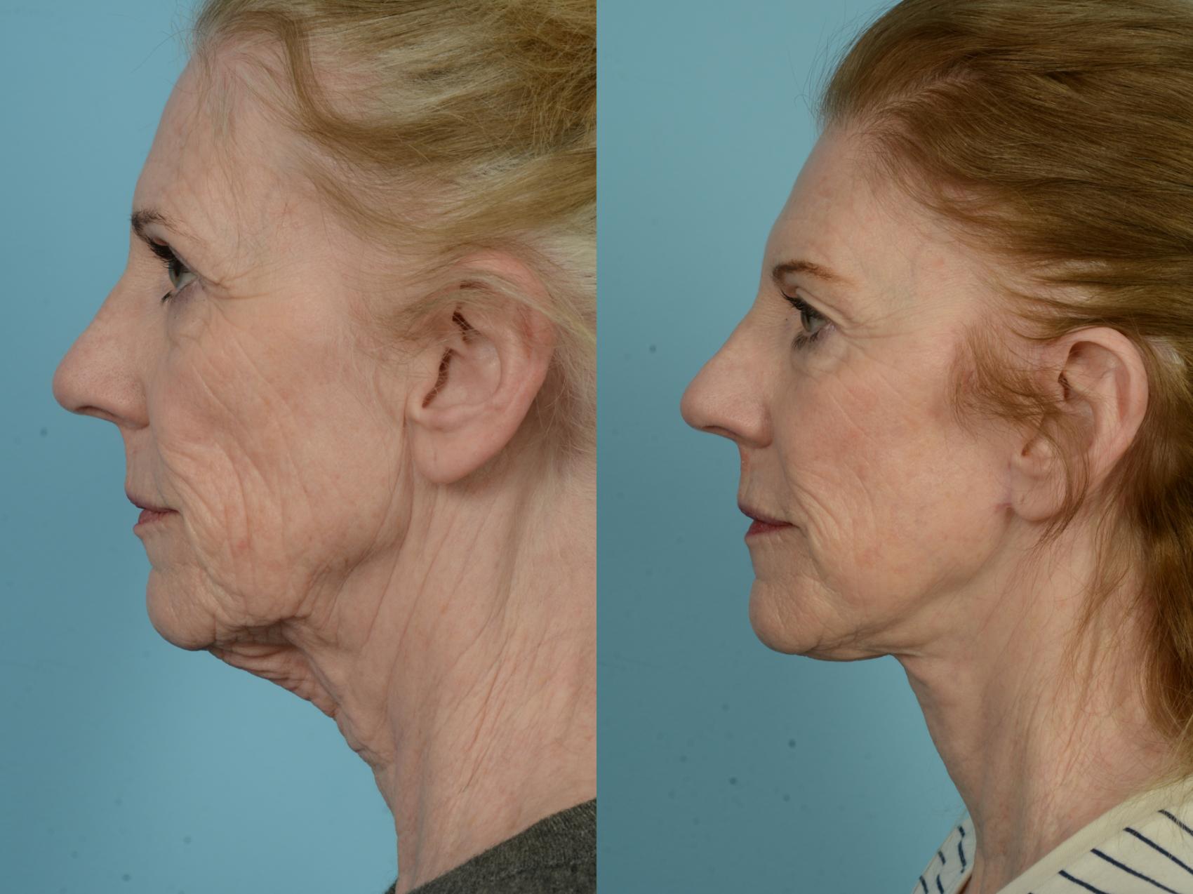 Before & After Deep Plane Facelift by Dr. Mustoe Case 834 Left Side View in Chicago, IL
