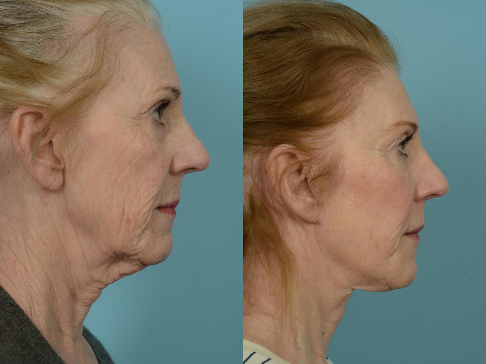 Before & After Deep Plane Facelift by Dr. Mustoe Case 834 Right Side View in Chicago, IL