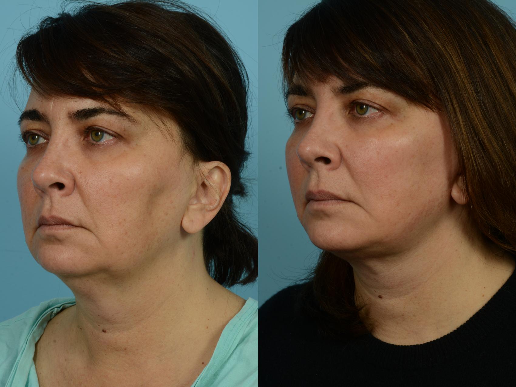 Before & After Deep Plane Facelift by Dr. Mustoe Case 928 Left Oblique View in Chicago, IL