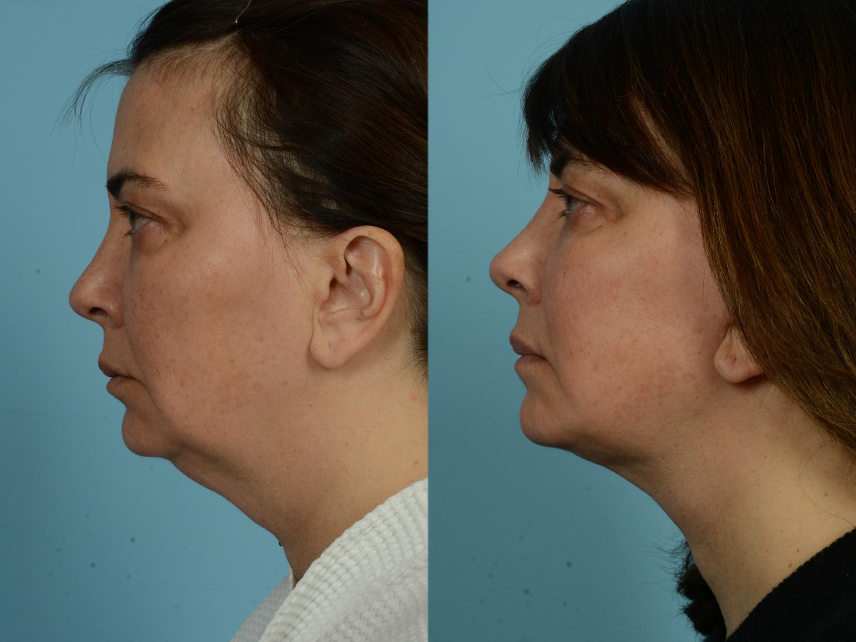 Before & After Deep Plane Facelift by Dr. Mustoe Case 928 Left Side View in Chicago, IL