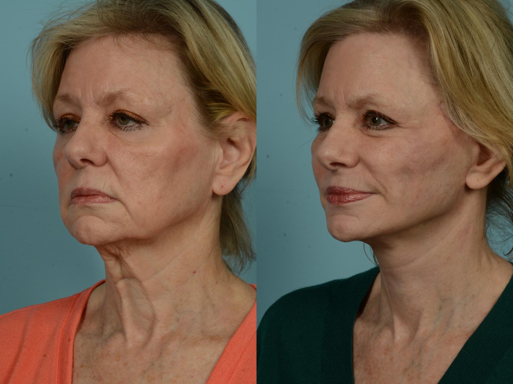 Before & After Dual Plane Facelift by Dr. Sinno Case 969 Left Oblique View in Chicago, IL
