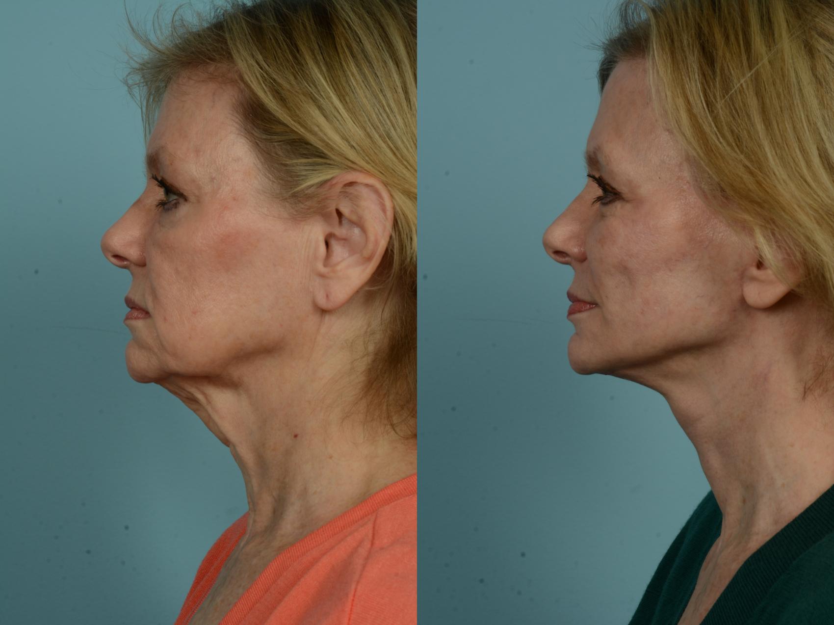 Before & After Dual Plane Facelift by Dr. Sinno Case 969 Left Side View in Chicago, IL