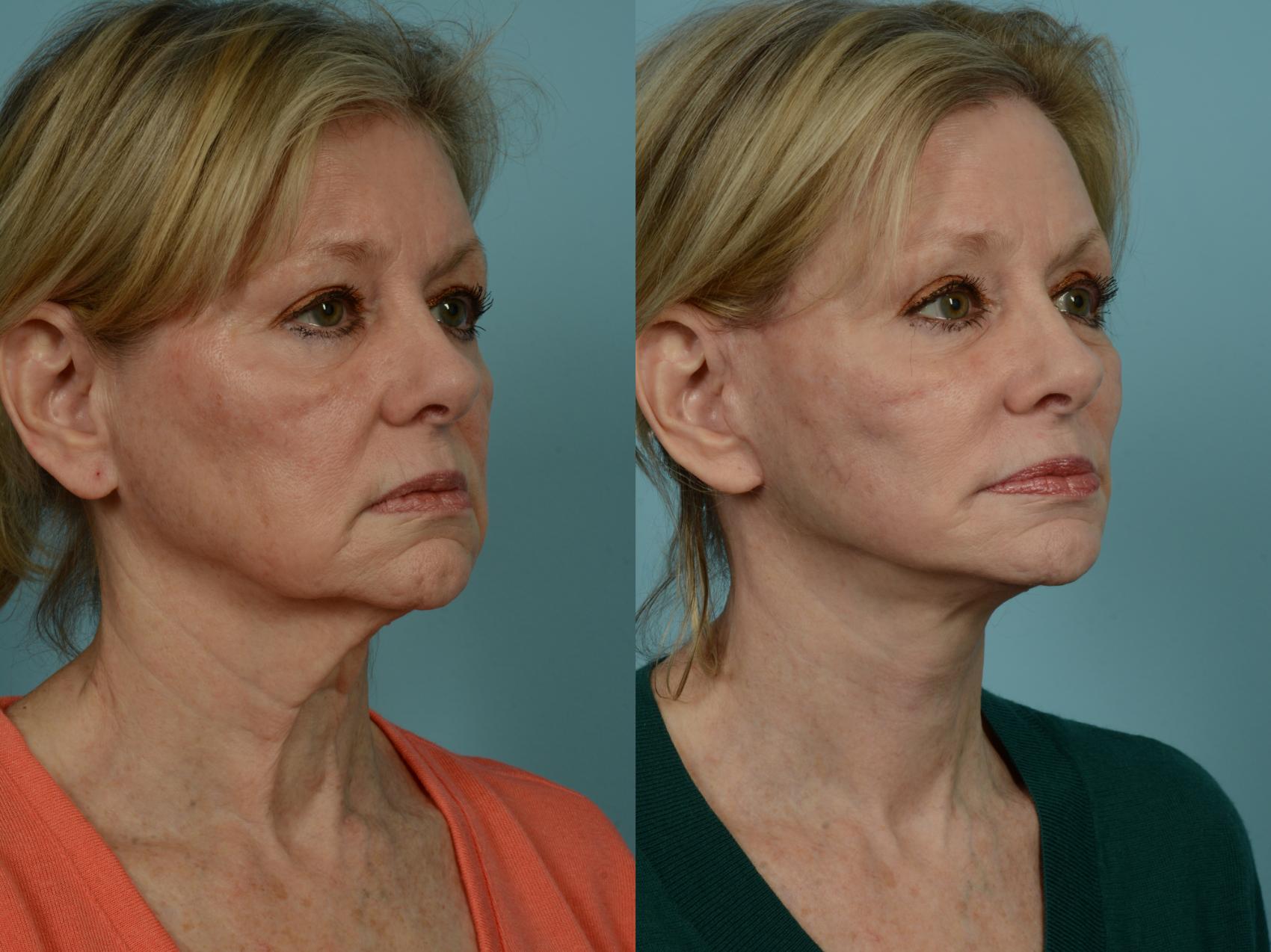 Before & After Dual Plane Facelift by Dr. Sinno Case 969 Right Oblique View in Chicago, IL