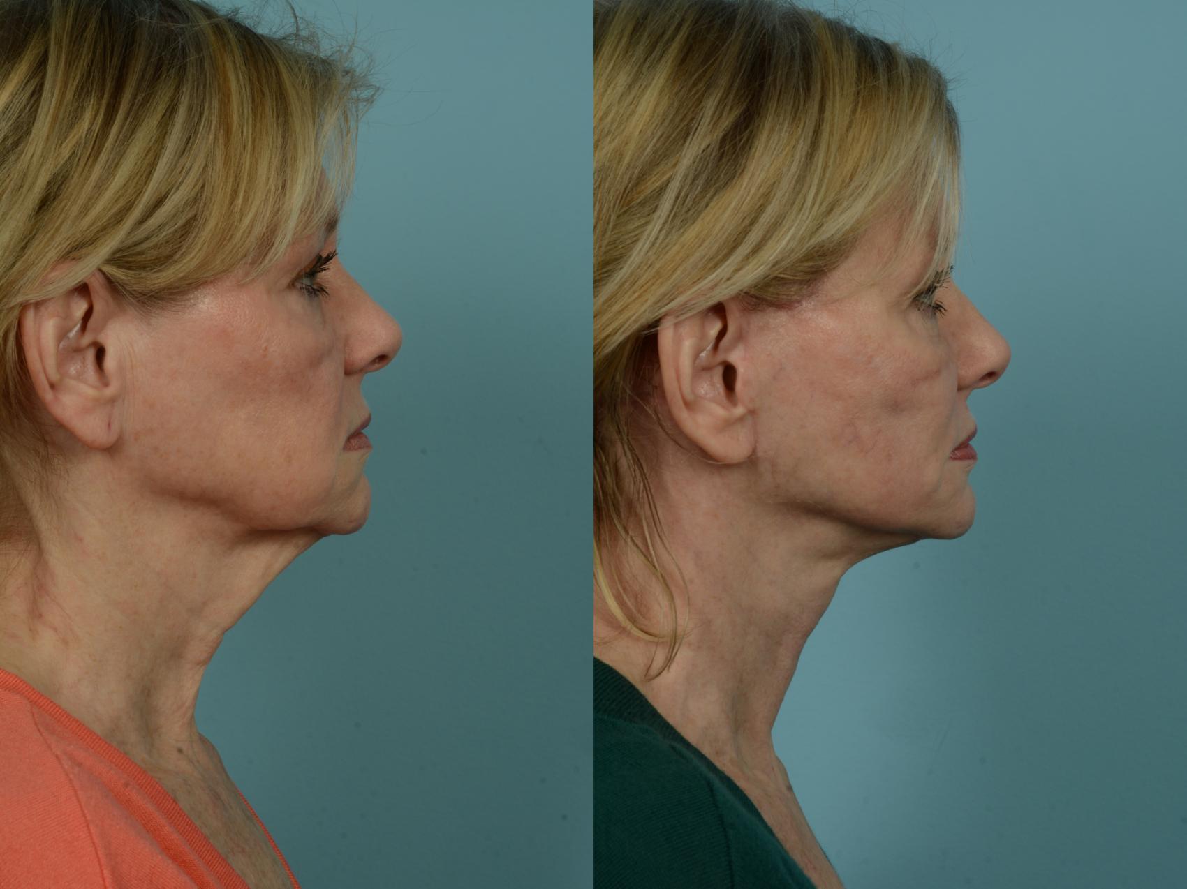 Before & After Dual Plane Facelift by Dr. Sinno Case 969 Right Side View in Chicago, IL