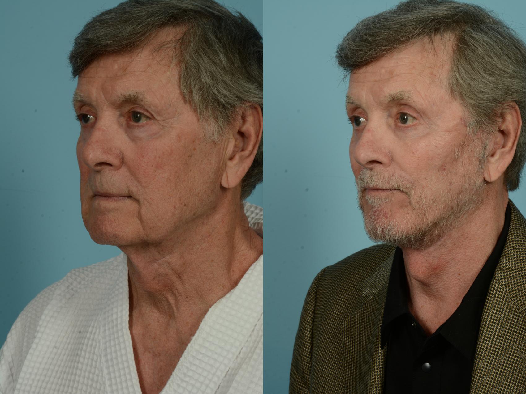Before & After Dual Plane Facelift by Dr. Sinno Case 983 Left Oblique View in Chicago, IL