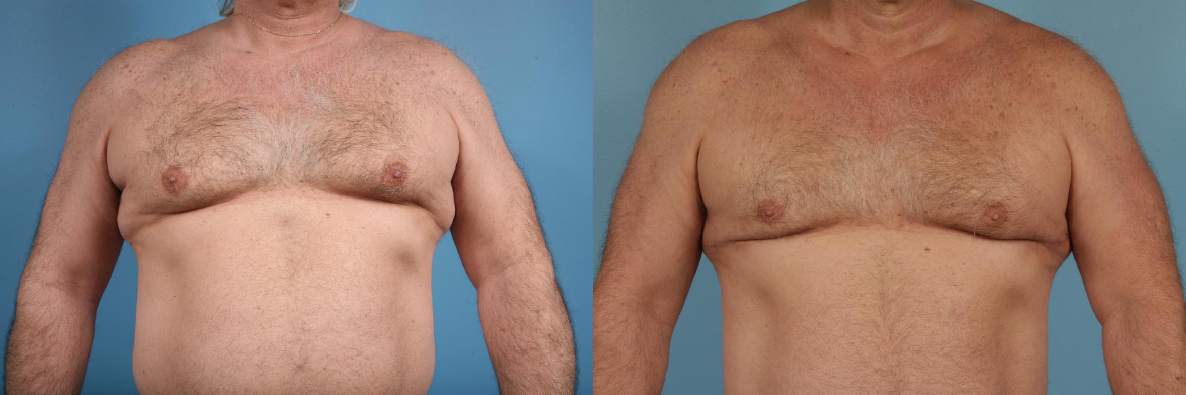 Before & After Male Breast Reduction (Gynecomastia) Case 174 View #1 View in Chicago, IL