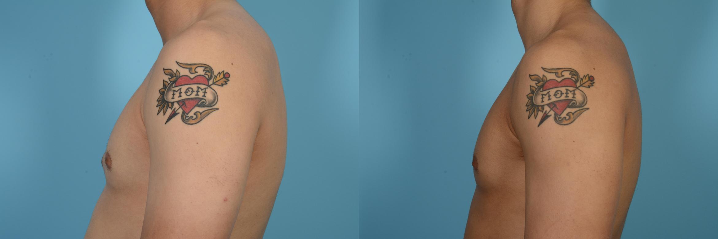 Before & After Male Breast Reduction (Gynecomastia) Case 517 View #1 View in Chicago, IL