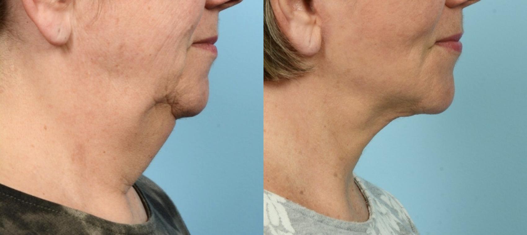Before & After Neck Lift by Dr. Mustoe Case 896 Right Side View in Chicago, IL