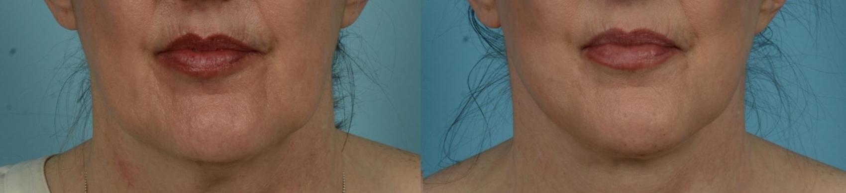 Before & After Perioral Rejuvenation by Dr. Mustoe Case 1062 Front View in Chicago, IL