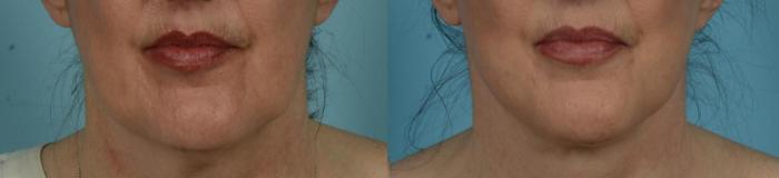 Before & After Perioral Rejuvenation by Dr. Mustoe Case 1062 Front View in Chicago, IL