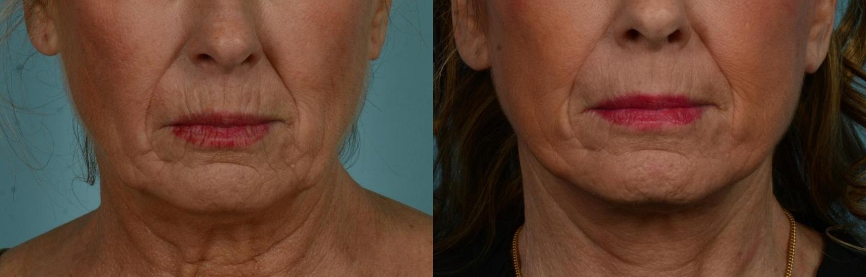 Before & After Perioral Rejuvenation by Dr. Mustoe Case 1070 Front View in Chicago, IL