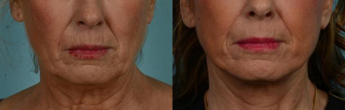 Before & After Perioral Rejuvenation by Dr. Mustoe Case 1070 Front View in Chicago, IL