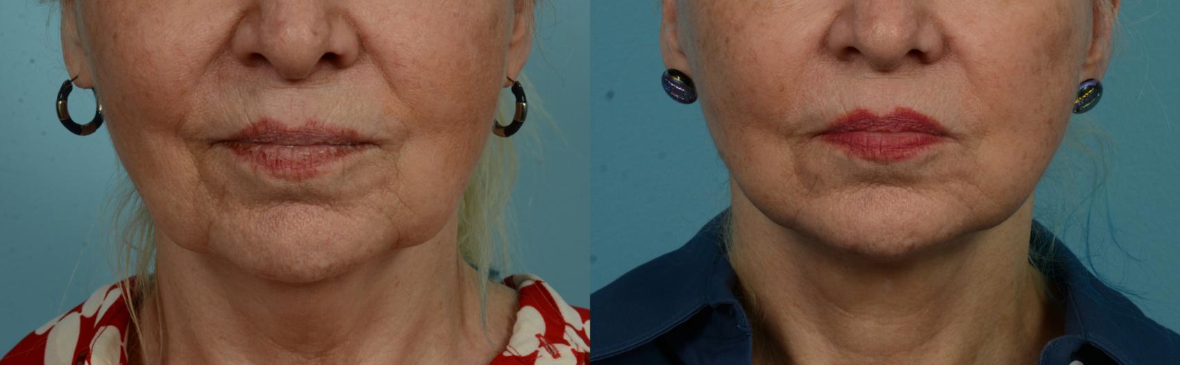 Before & After Perioral Rejuvenation by Dr. Mustoe Case 1075 Front View in Chicago, IL