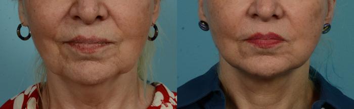 Before & After Laser Resurfacing by Dr. Mustoe Case 1075 Front View in Chicago, IL