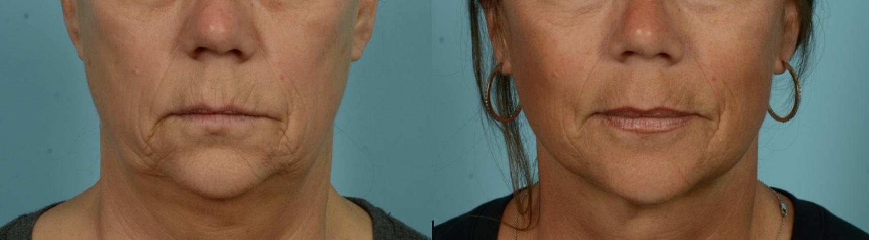 Before & After Perioral Rejuvenation by Dr. Mustoe Case 1076 Front View in Chicago, IL