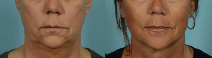 Before & After Laser Resurfacing by Dr. Mustoe Case 1076 Front View in Chicago, IL