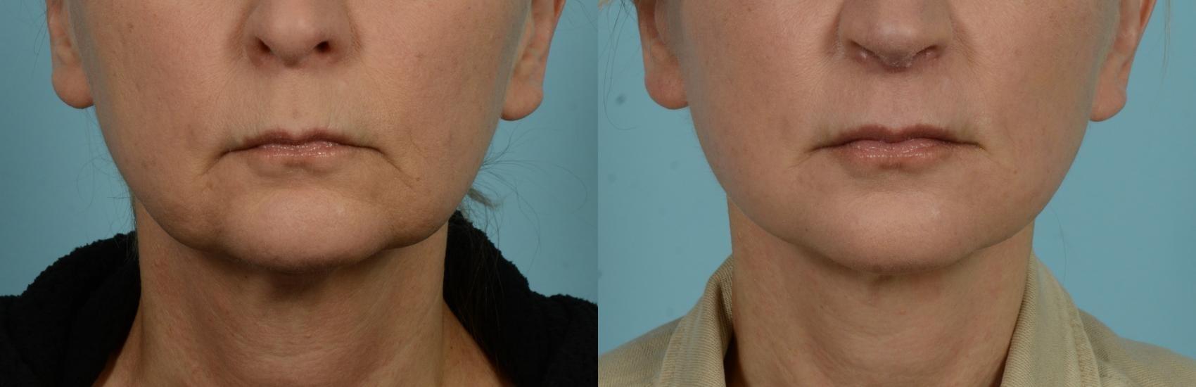 Before & After Perioral Rejuvenation by Dr. Mustoe Case 1083 Front View in Chicago, IL