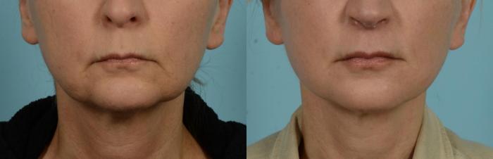 Before & After Perioral Rejuvenation by Dr. Mustoe Case 1083 Front View in Chicago, IL