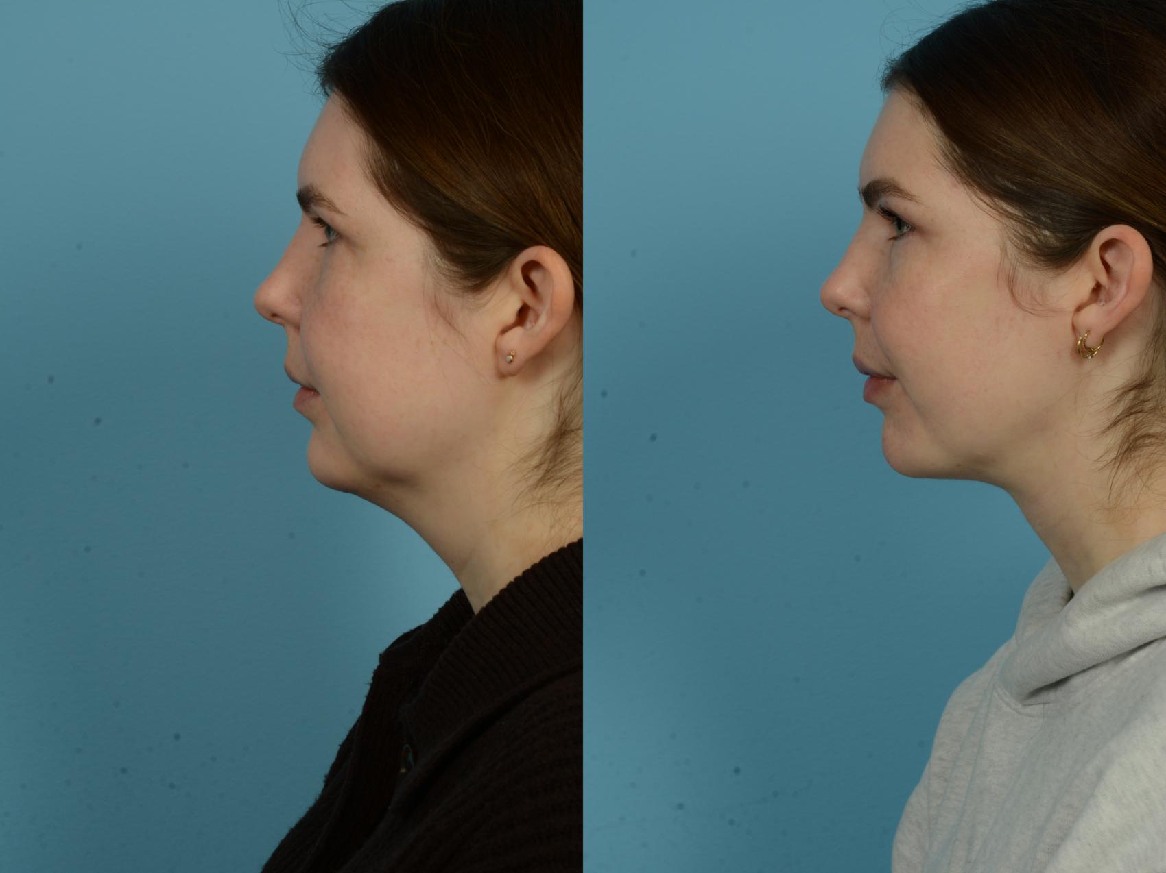 Before & After Precision TX Laser Case 1086 Left Side View in Chicago, IL