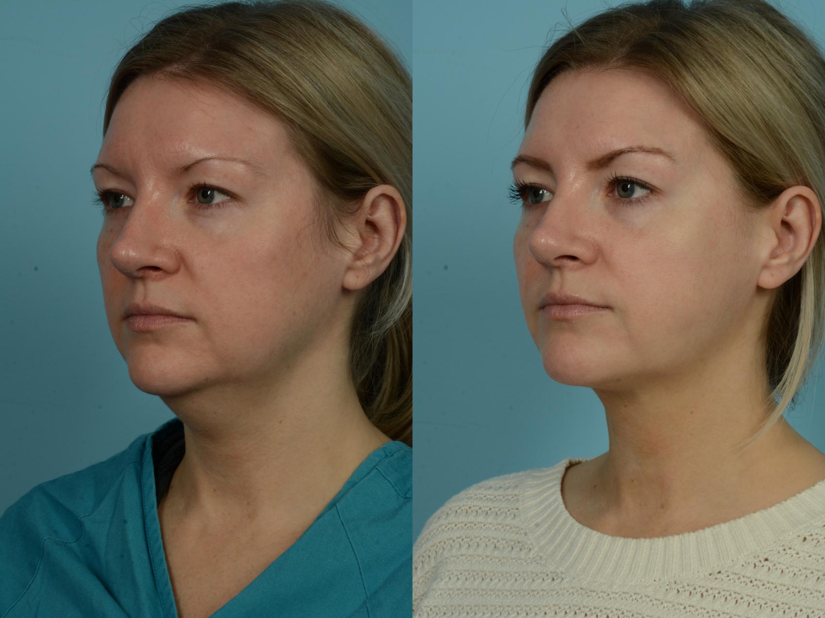 Before & After Precision TX Laser Case 870 Left Oblique View in Chicago, IL